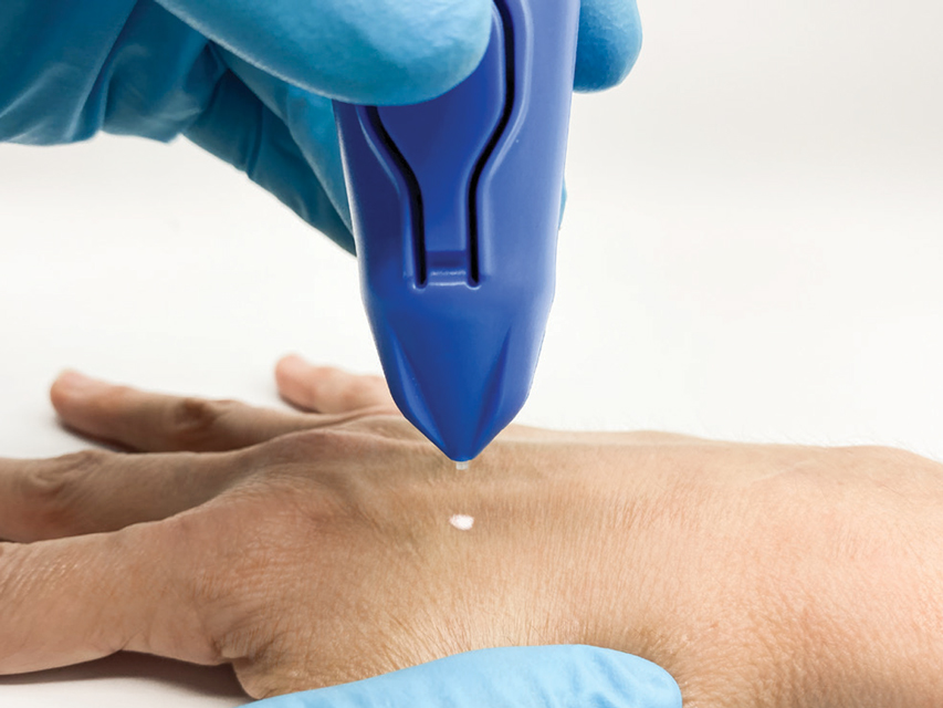 DISPOSITIF DE CRYOCHIRURGIE CRYOMEGA avec cartouche 16 g