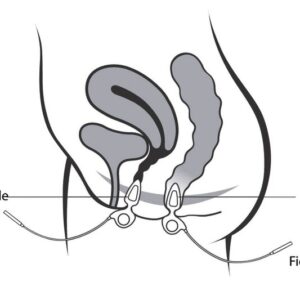 Sonde Anale/vaginale Anuform® Neen