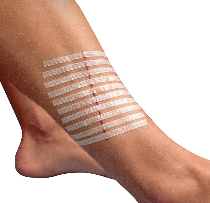Suture 3M™ Steri-Strip™ – Image 3