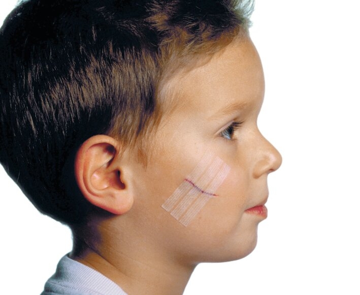 Suture 3M™ Steri-Strip™ – Image 4